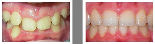 Case 3 – Protruding Teeth / Overbite