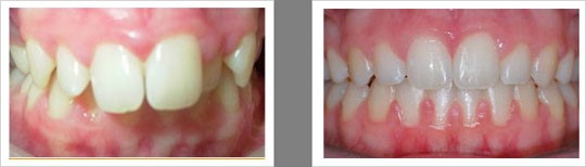 Case 5 – Deep Bite