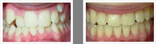 Case 7 – Posterior Crossbite