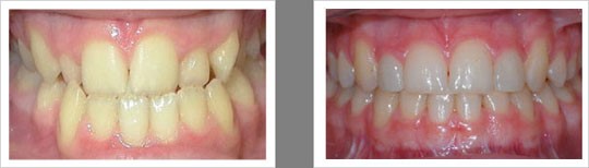 Case 8 – Anterior Crossbite