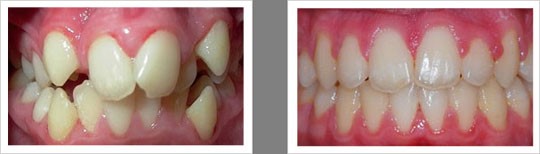 Case 9 – Missing Teeth