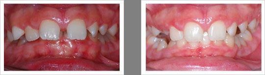 Case 10 – Impacted Teeth