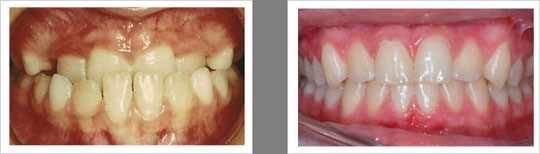 Case 11 – Ectopic Teeth