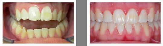 Case 12 – Thumb Sucking